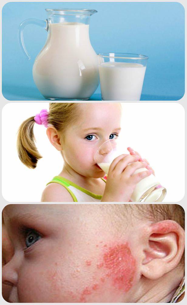 Диета Детям Аллергия На Молоко