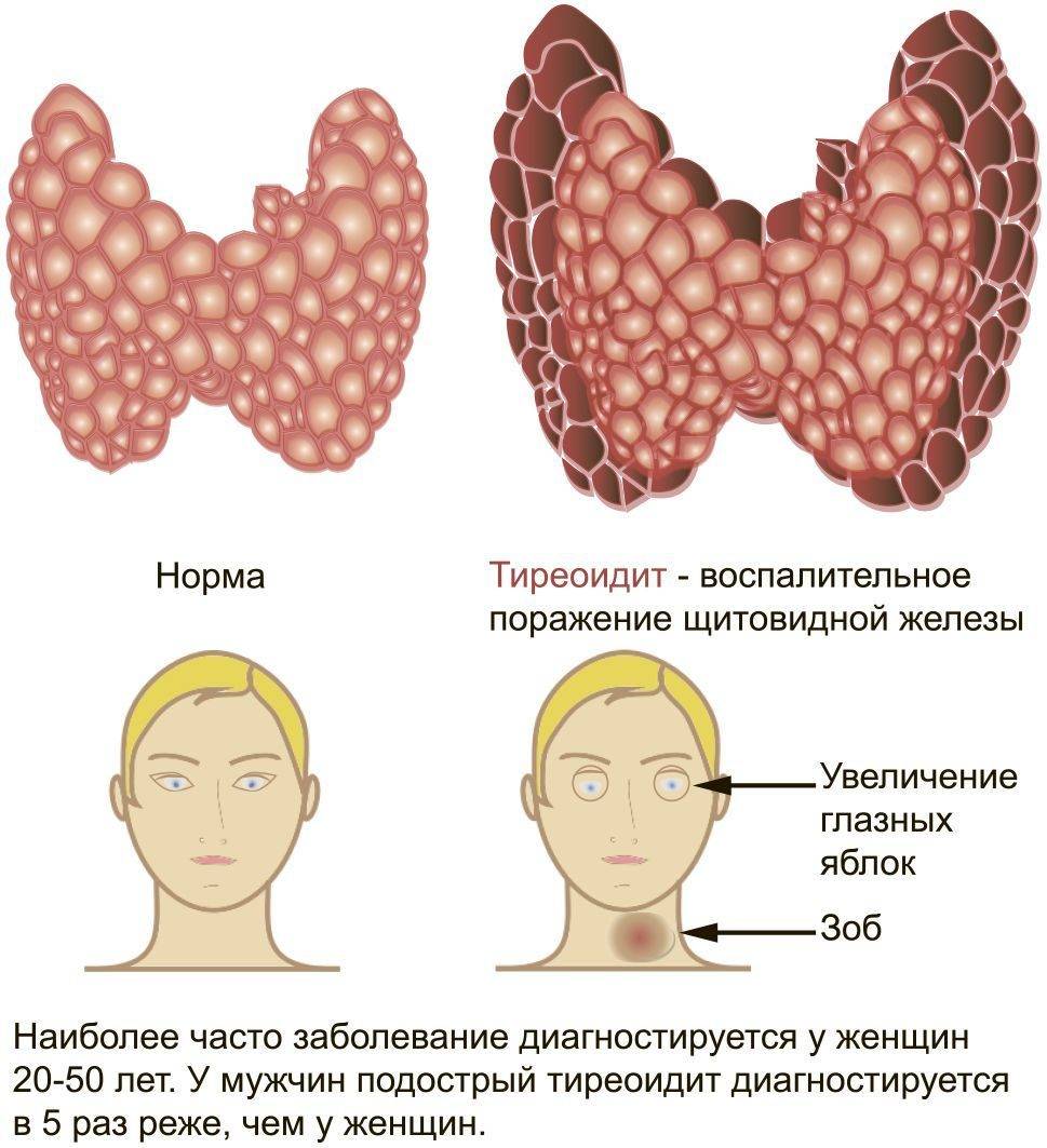 Тиреотоксикоз Щитовидной Железы Диета И Образ Жизни