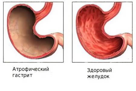 Хронический гастрит с очаговой неполной кишечной метаплазией