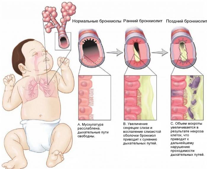 Острый бронхиолит: клинические рекомендации для детей и взрослых, код по мкб-10, протоколы лечения, симптомы, характерно развитие выраженной недостаточности