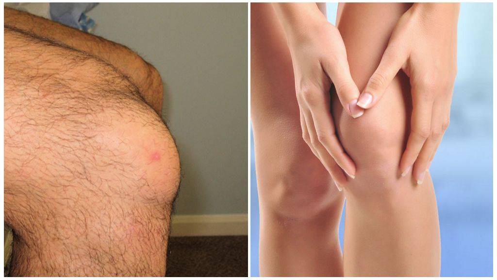Супрапателлярный бурсит коленного сустава: симптомы и лечение | все о суставах и связках