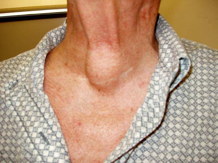 Причины заболевания щитовидной железы