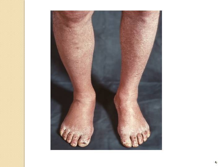 Нарушение кровообращения онемение ногах лечение