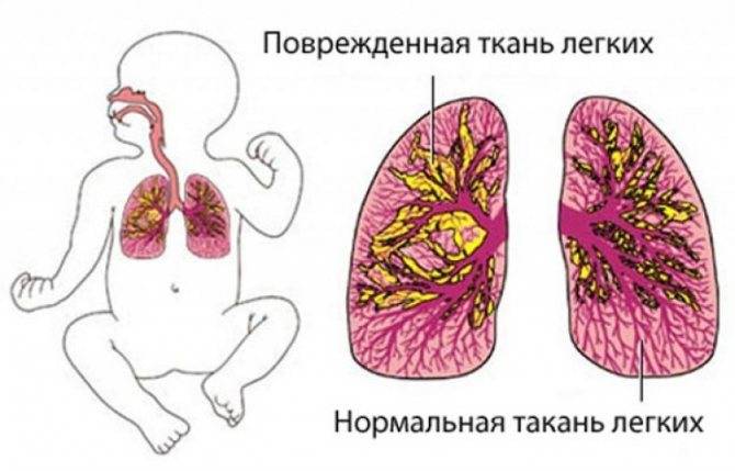 Очаговая пневмония у детей - мелкоочаговая правосторонняя у ребенка, симптомы и лечение хронической