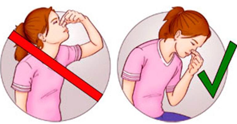 Как остановить кровь из носа: что делать при носовом кровотечении