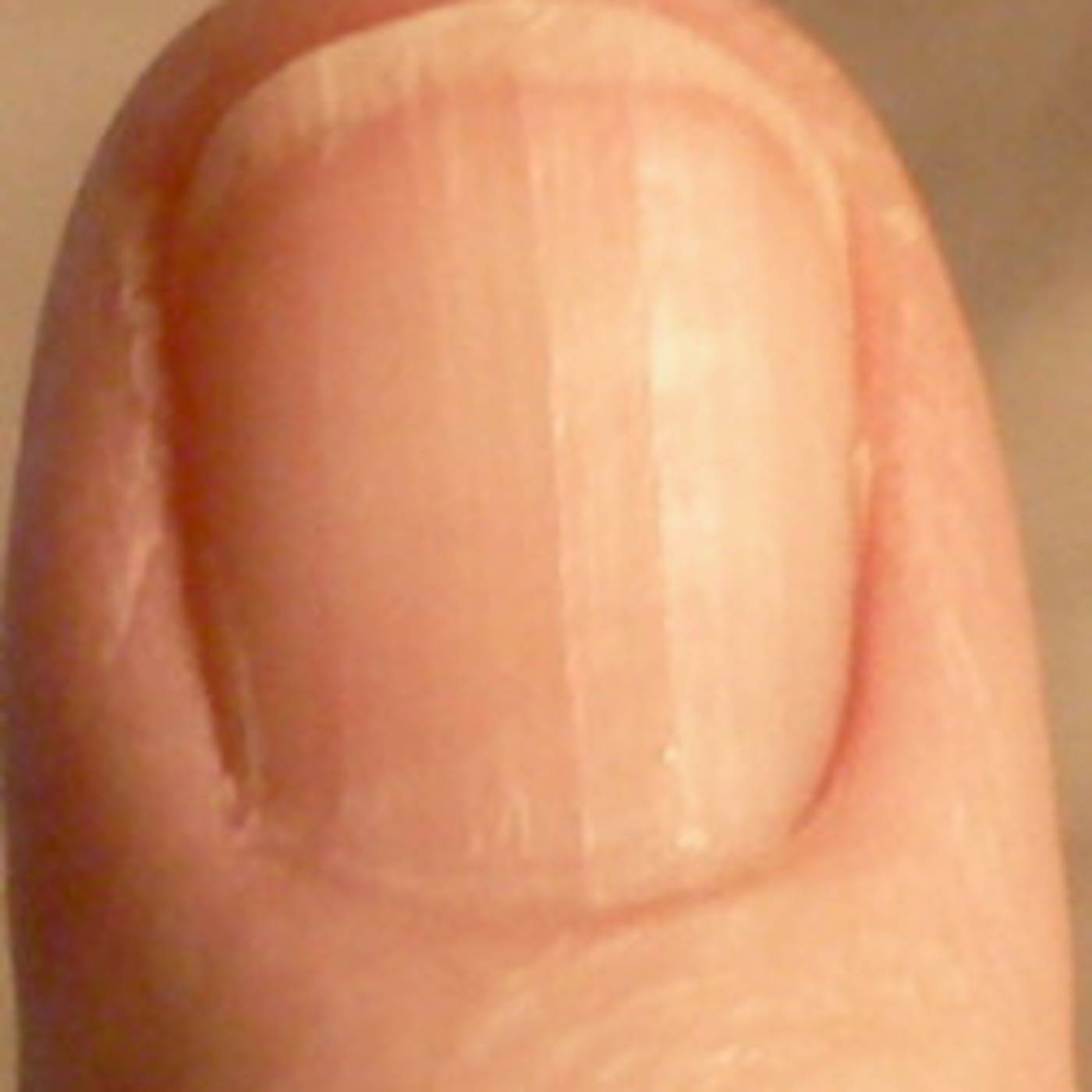 Поперечные полосы на ногтях рук: причины внешние и внутренние