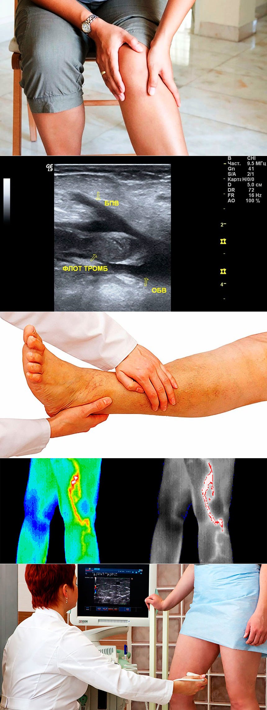 Глубокий тромбофлебит (тромбоз) нижних конечностей: симптомы, диагностика, лечение
