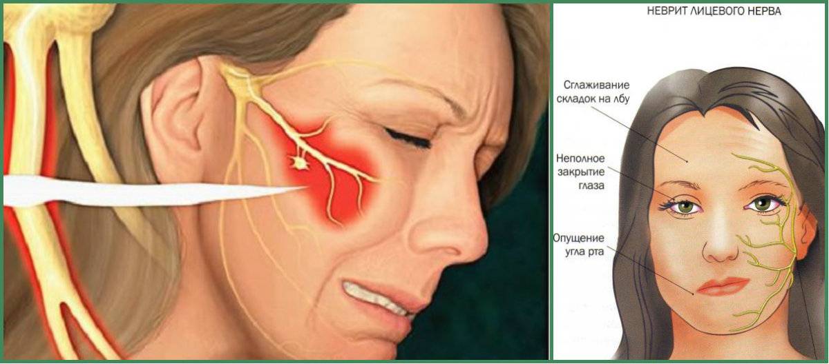 Воспаление тройничного нерва на лице: как определить и вылечить заболевание