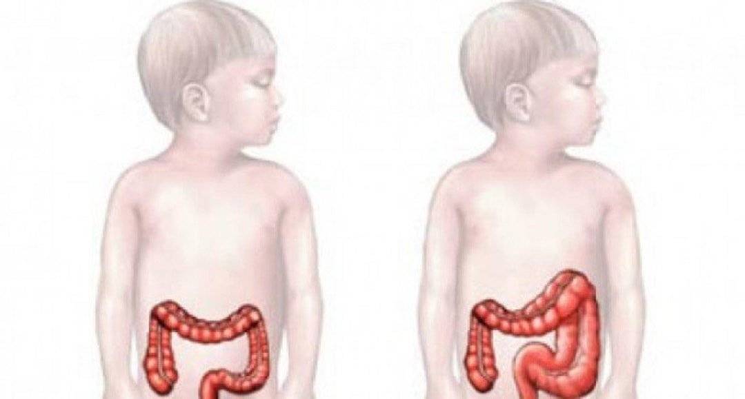 Долихосигма кишечника у детей: виды, причины возникновения, симптомы, диагностика и лечение
