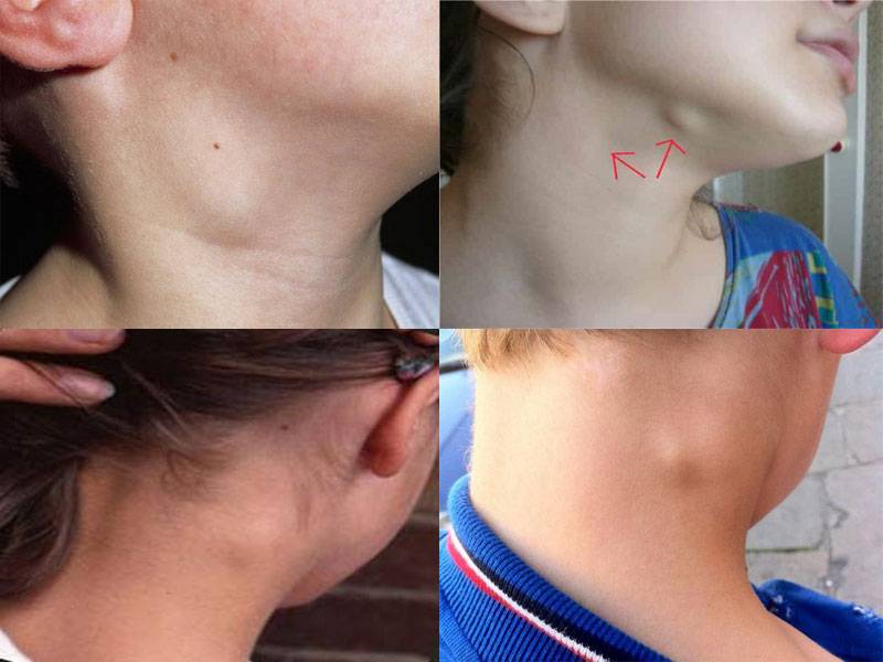Комаровский - увеличенные лимфоузлы на шее у ребенка, лимфаденит (9 фото): увеличенные лимфоузлы на шее у с одной стороны