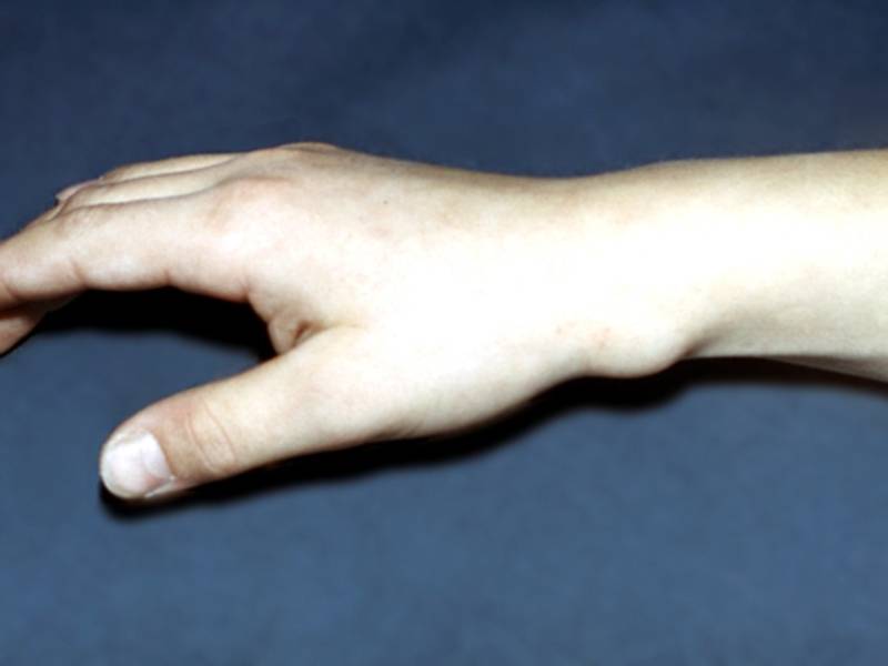 Шишка на запястье руки сверху (твердая): что делать, лечение на коже народными средствами