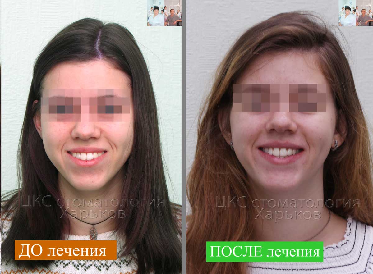 Как меняется лицо после брекетов, почему меняют его форму, какие именно изменения, как изменился человек: фото до и после ношения