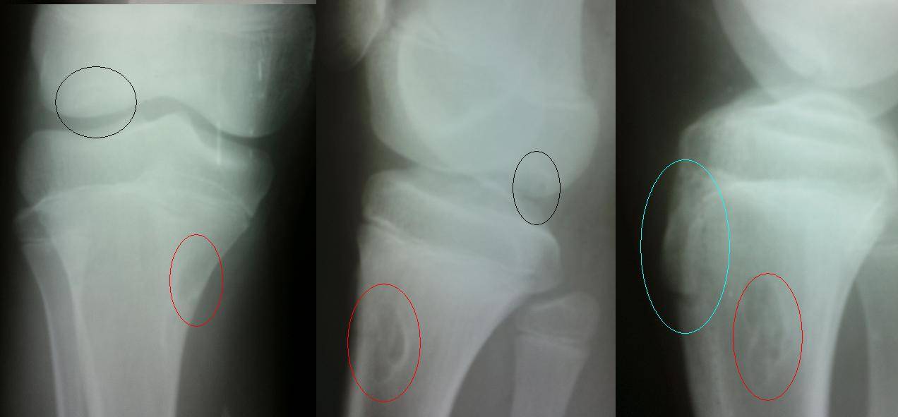 Болезнь кенига коленного сустава у детей спортсменов - лечение