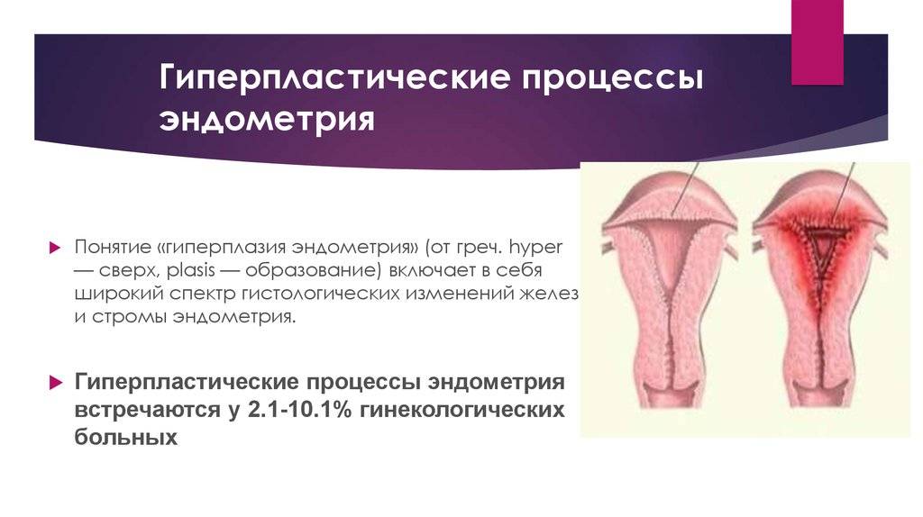 Очаговая гиперплазия эндометрия