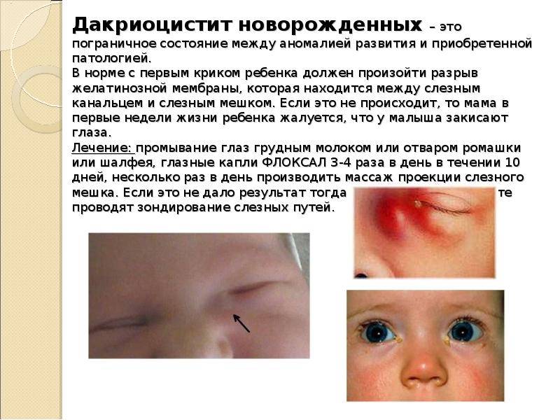 Лечение дакриоцистита без операции | лечение глаз