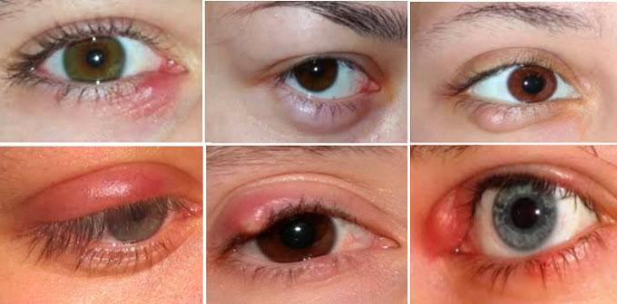 Ячмень на глазу у ребенка — причины, симптомы и лечение (фото)