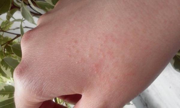Аллергия на лице: фото, чем лечить на щеках прыщи