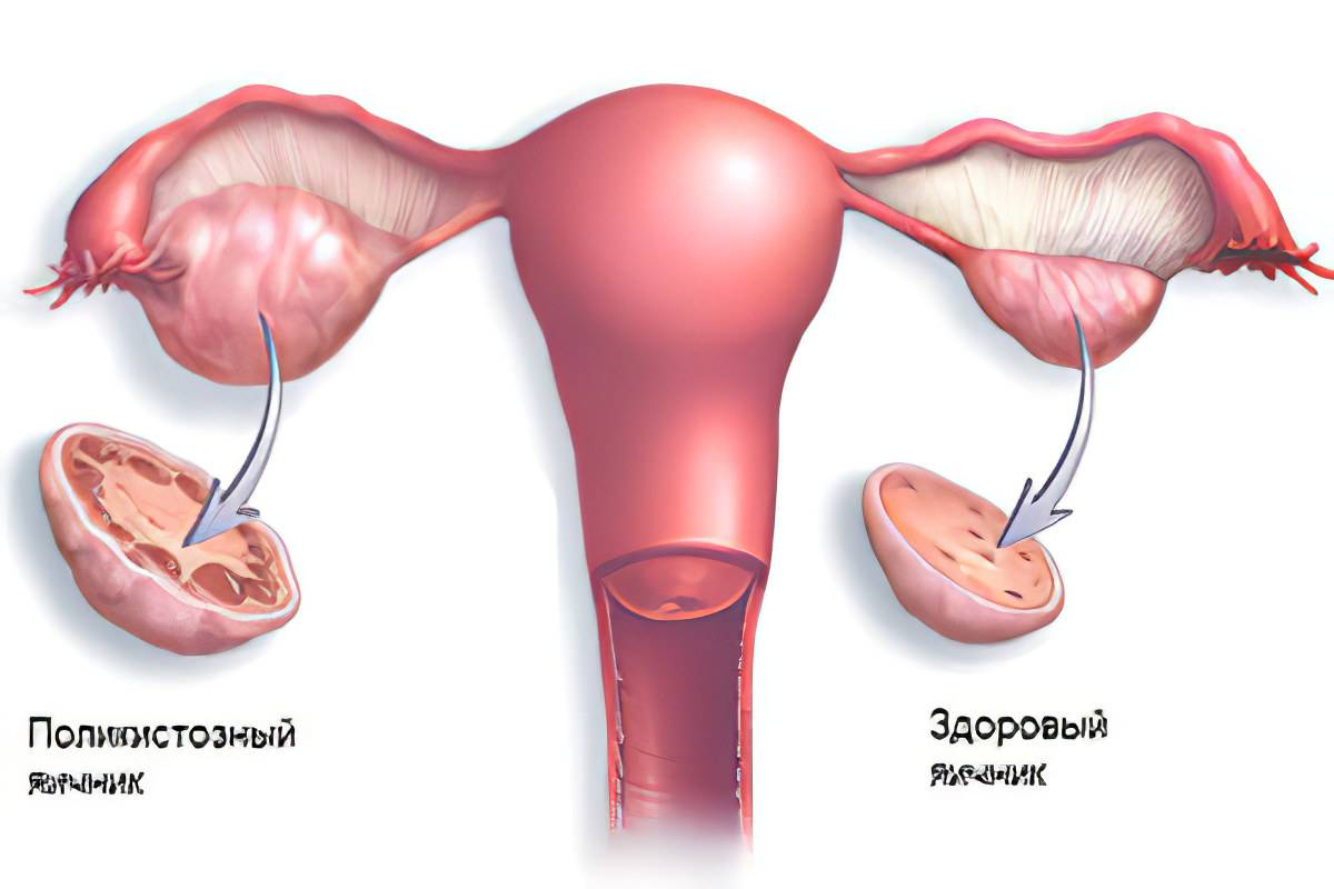 Синдром истощения яичников - как лечить и возможна ли беременность