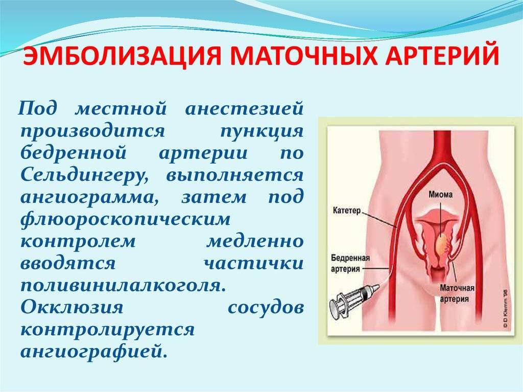 Эма — эмболизация маточных артерий при миоме матки
