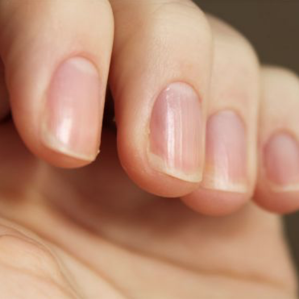 Полоски на ногтях причины вертикальные у женщин. Приплюснутые ногти на руках. Тонкие ногти.