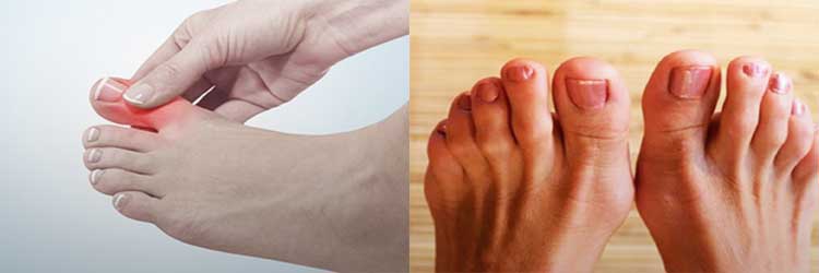 Болит сустав большого пальца на ноге: причины, лечение
