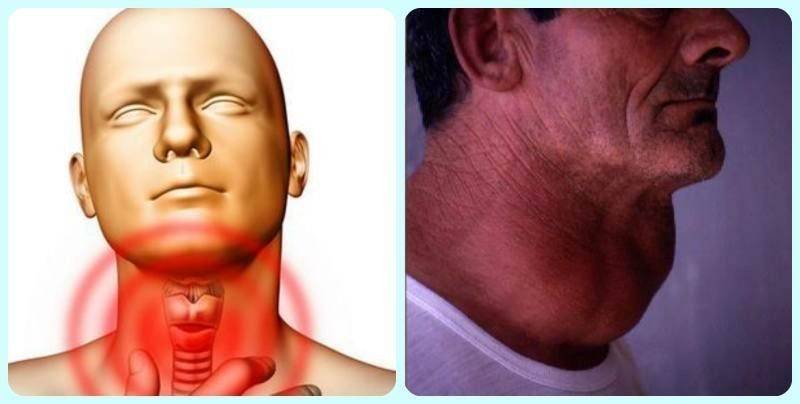 Симптомы заболевания щитовидной железы у женщин, фото | pro shchitovidku