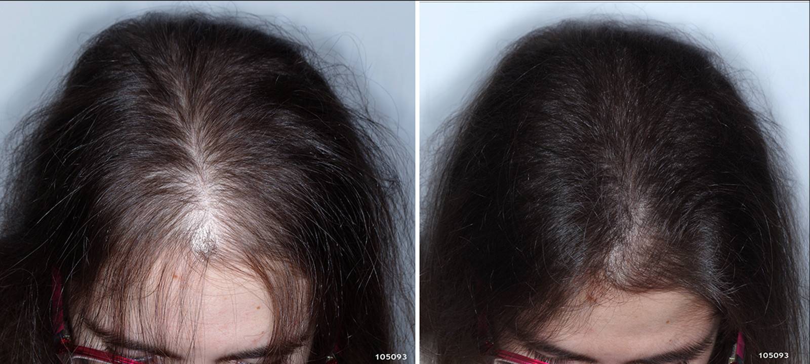 Причину выпадения волос после 40. Андрогенная алопеция алопеция. Андрогенная алопеция Гамильтон. Диффузная телогеновая алопеция.