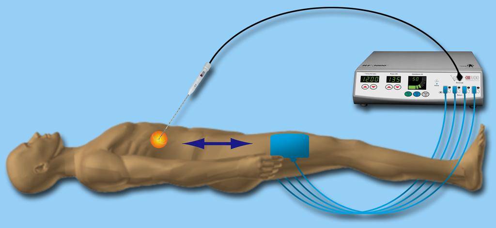 Радиочастотная денервация позвоночных суставов – возможные осложнения после операции