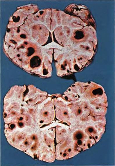 Метастазы в головном мозге: симптомы и продолжительность жизни