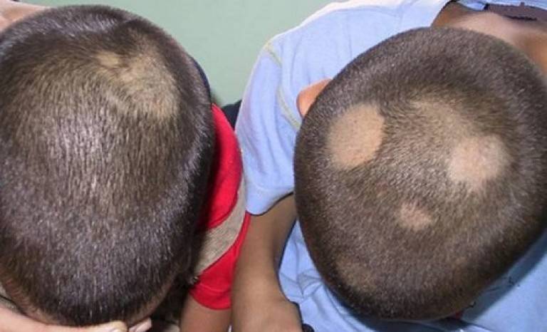 Лишай на голове у ребенка: как лечить, фото лишая в волосах