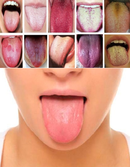 Сухость во рту при коронавирусе: есть ли симптомом, причины, лечение