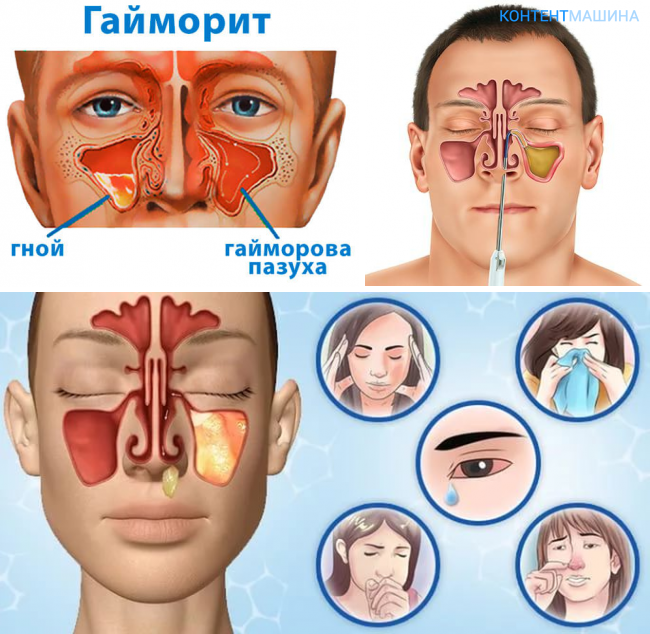 Болячки в носу: причины появления, виды, способы лечения