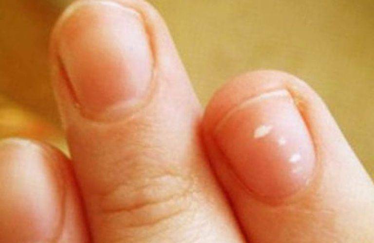 Черные точки на ногтях: причины, лечение, профилактика