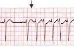 Синусовый ритм сердца на экг - что это значит в диагностике кардиопатологий