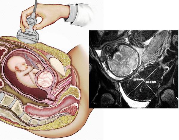 Можно ли забеременеть без матки, возможна ли внематочная беременность