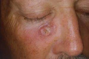 Старческая кератома мкб 10. кератоз кожи: фото, лечение, типы и виды