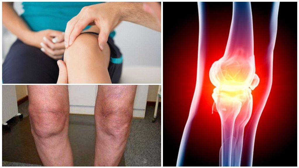 Болит колено при сгибании. что делать при боли в колене