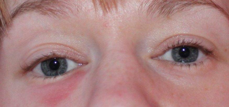 Аллергический отек глаз: причины развития, симптомы и лечение