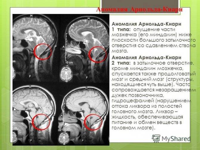 Аномалия арнольда-киари: симптомы и лечение