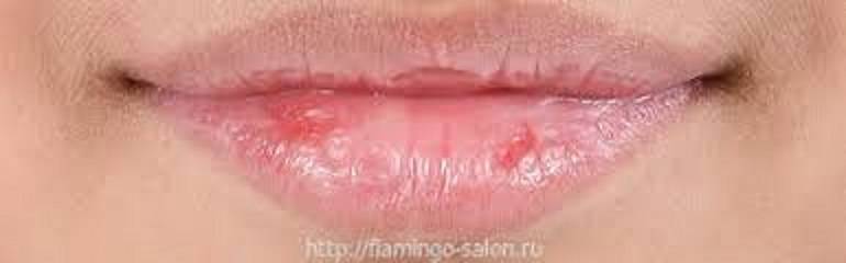 Трещины и сухость в уголках губ и рта у взрослых: причины, лечение, народные средства