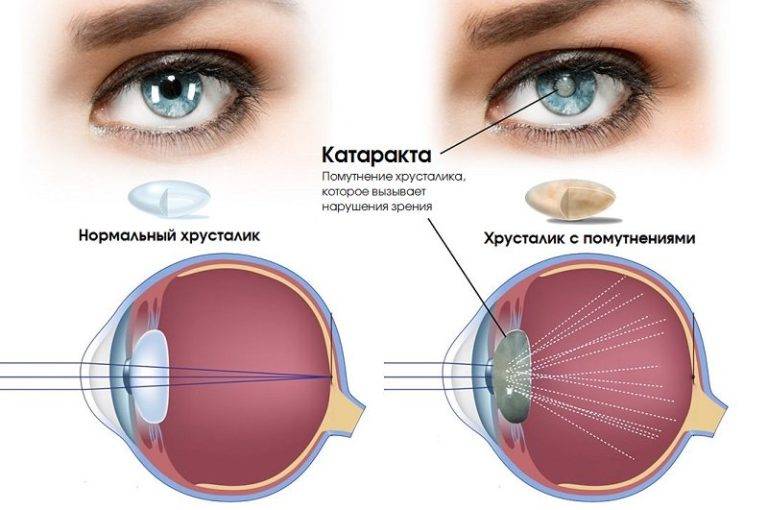 Эффективность лечения катаракты народными средствами