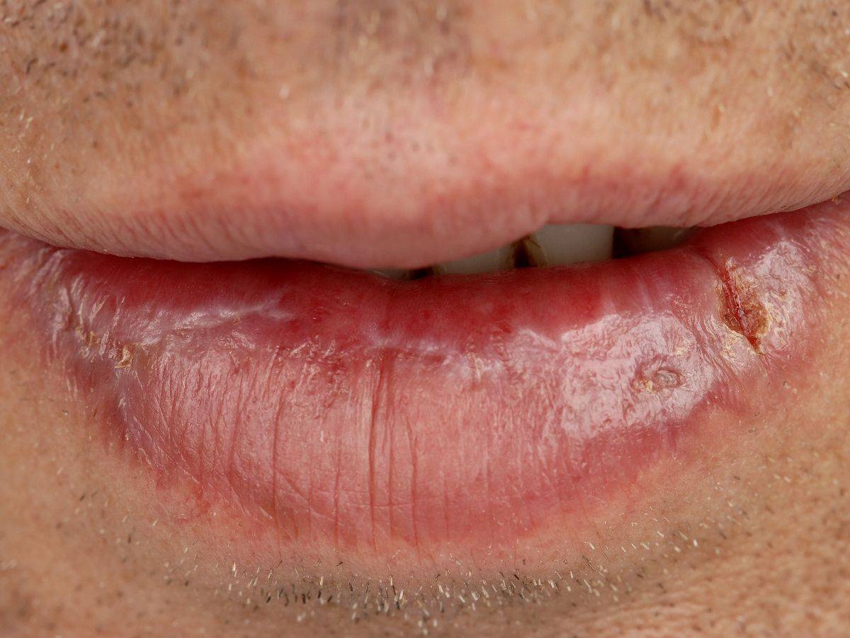 Трещины в уголках губ у ребенка - лечение народными средствами