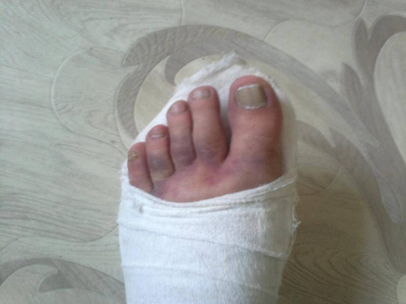 Как определить перелом пальца на ноге: основные признаки и симптомы травмы