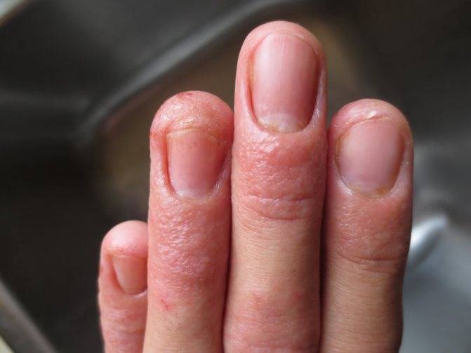 Зуд между пальцами ног: чем лечить в домашних условиях, причины зудения | mfarma.ru