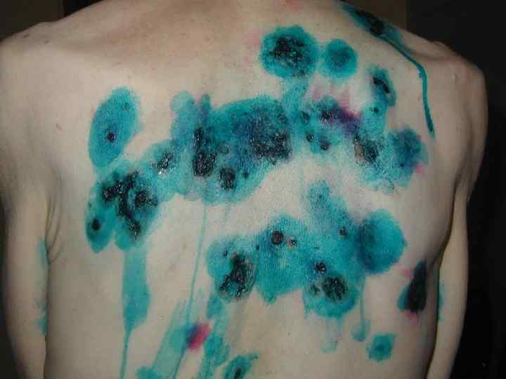 Причины и методы терапии пузырчатки на коже у детей