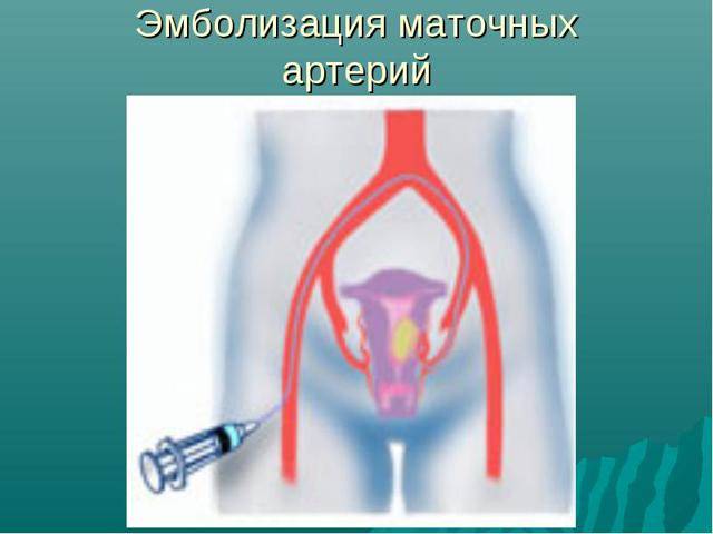 Эмболизация маточных артерий при миоме матки (эма): отзывы о процедуре, цены