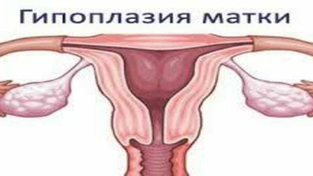 Гипоплазия матки - степени, признаки, причины, лечение