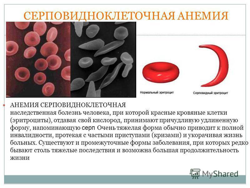 Серповидноклеточная анемия. причины, симптомы, диагностика и лечение патологии
