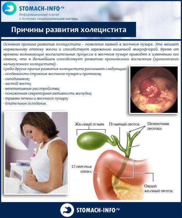 Перегиб желчного пузыря - симптомы и лечение, последствия