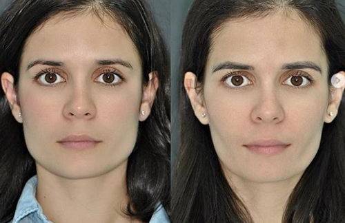 Брекеты меняют лицо фото до и после